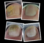 lunula-before-and-after-for-webinar