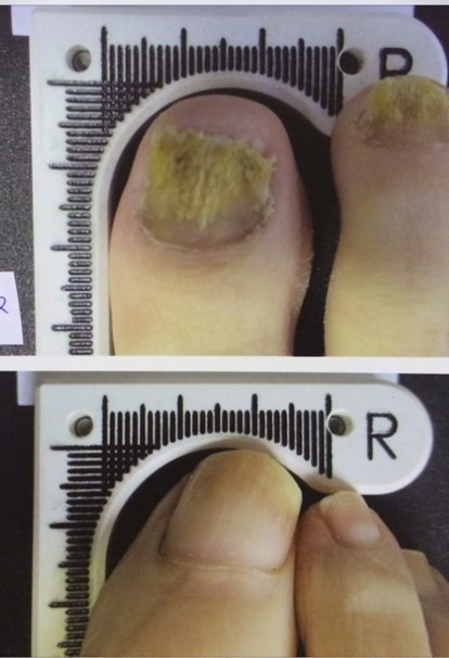 Lunula Before and After